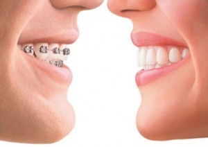 braces-300x212