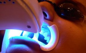 laser-teeth-whitening